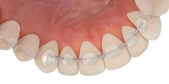 Retainers After Invisalign Treatment - Dr. Tais Trevelin DMD